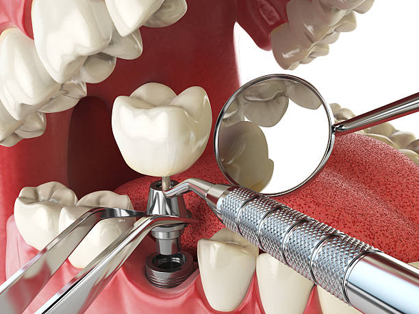 Best Root Canal Emergency Dentist  in Comstock Northwest, MI